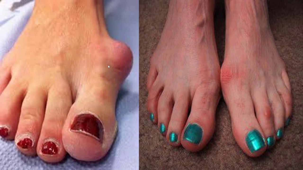 Is Bunion Surgery for Me? Lake Mead Hospital