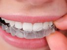 Everything You Need to Know About Invisalign in Dentistry