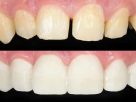 Dental Bonding Explained